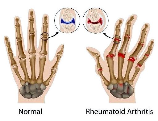 Ревматоидный артрит: симптомы, причины и лечение