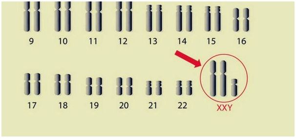 Синдром Клайнфельтера: лишняя Х-хромосома у мужчин
