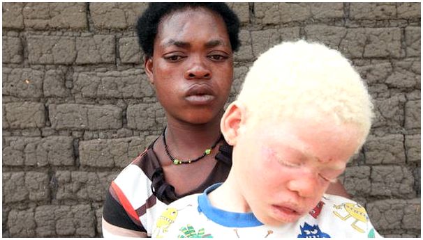 Люди-альбиносы: за пределами физического аспекта