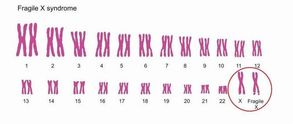 Синдром ломкой Х-хромосомы: симптомы, причины и лечение