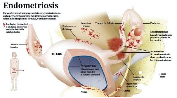 Adenomiosis y endometriosis