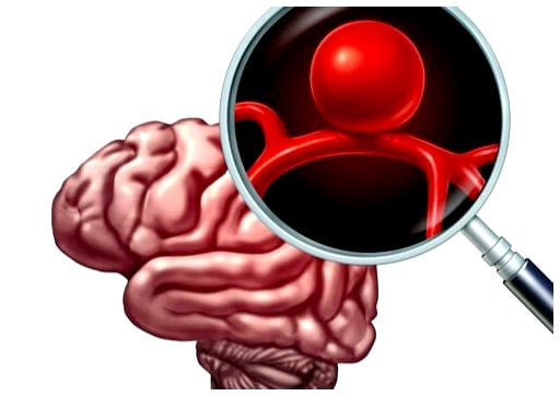 Аневризма головного мозга: определение, симптомы и лечение